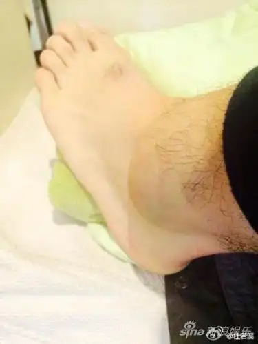 严屹宽脚肿淤青带伤拍戏杜若溪心疼老公