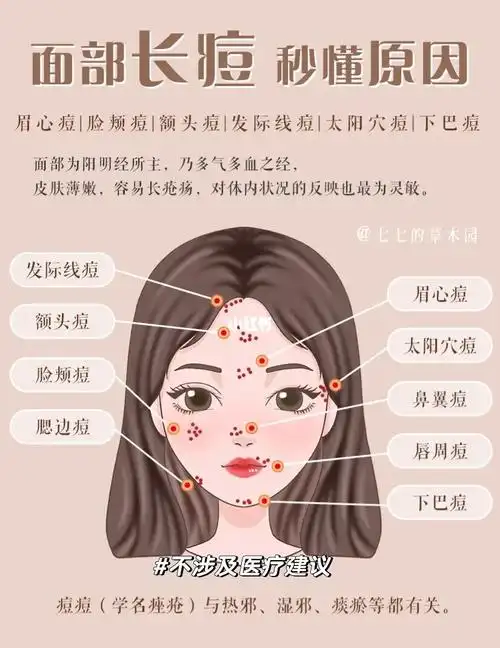 痘痘60不同部位长痘原因73按区祛痘教程