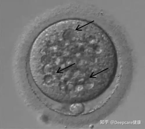 正常卵子和异常卵子的区别