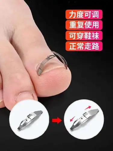 一折甲沟炎矫正器 翘甲器_指甲钳工具脚趾甲指勾外翻上翘脚指甲外翻
