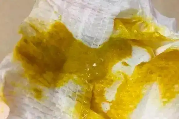 大便拉出油脂图片(大便拉出油脂怎么回事)-江湖救急网