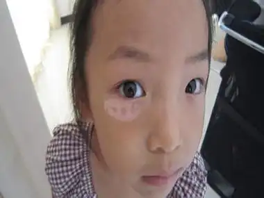 早期白癜风症状图片