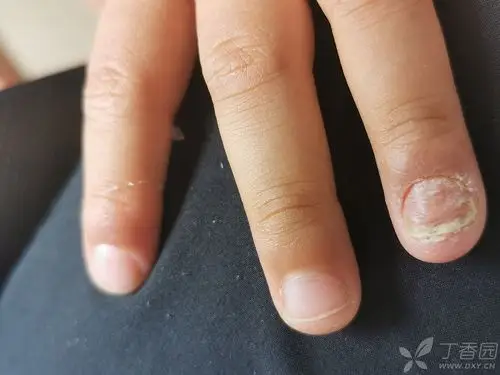 头一次见病例,自己考虑扁平苔癣病变的指甲.