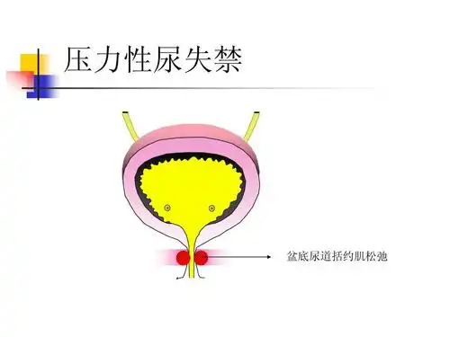 尿失禁病人健康ppt