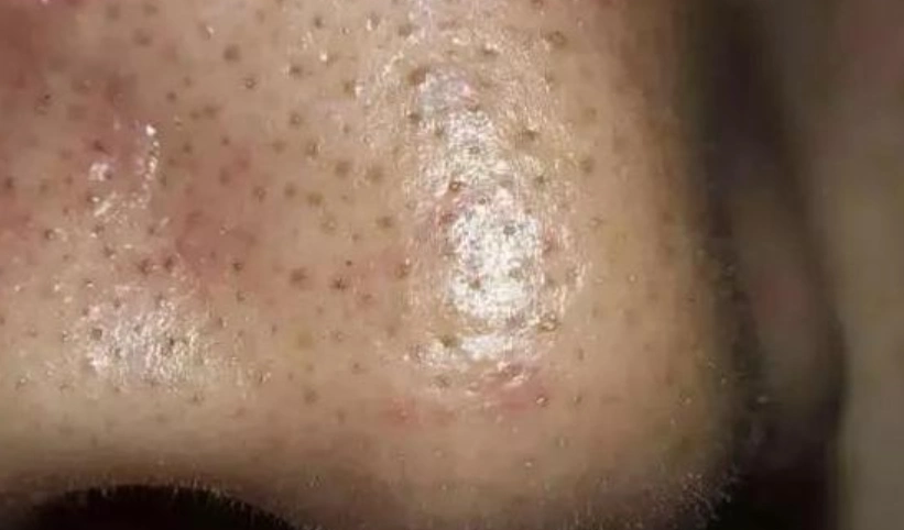 送你3招清除黑头皮肤光滑!__凤凰网