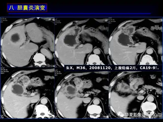 胆囊炎影像诊断