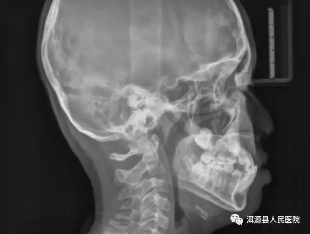 头颅侧位片可用于口腔正畸,正颌治疗前,中,后牙及颌骨相对位置的改变