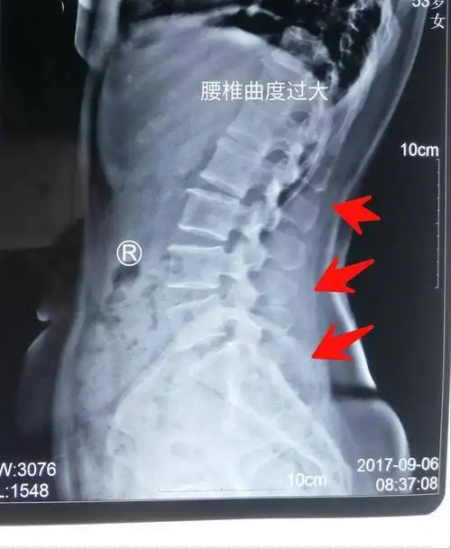 一:腰椎曲度过大的睡姿.答案是肯定不行的.