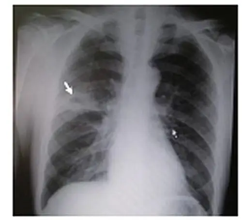 肺脓肿与普通肺炎相鉴别