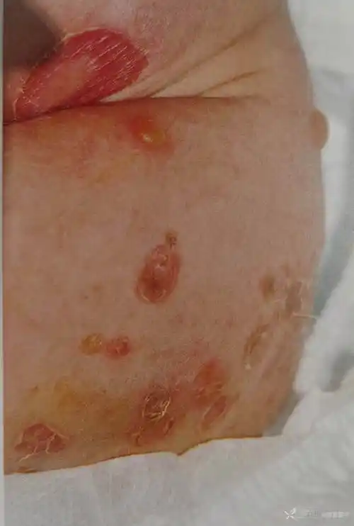 第13篇金黄色葡萄球菌烫伤样皮肤综合征温故而知新