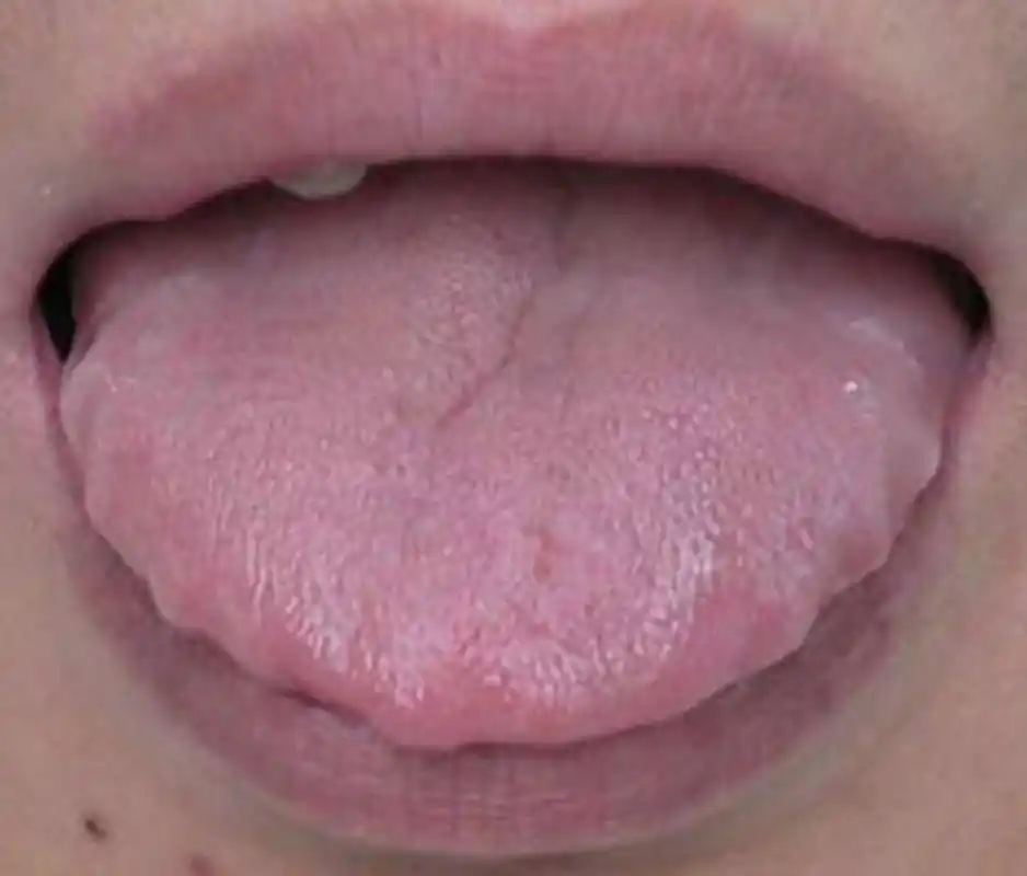 有的人舌头两边有一圈牙齿印,而且舌质淡苔白,舌体胖大,这都是脾胃