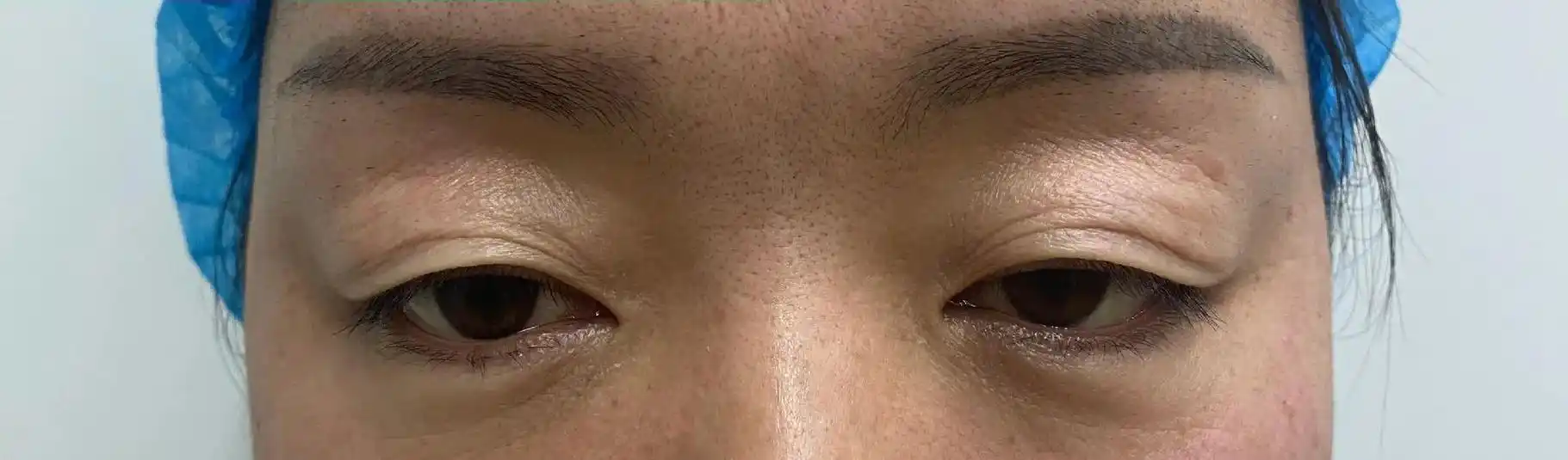 眼睛不小,单眼皮,只因上眼皮长期下垂 - 抖音