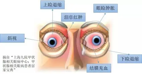 唐都眼科科普系列之甲状腺相关性眼病篇