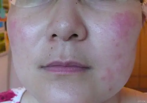 【求助】严重湿疹附加脸部过敏? ——现在治疗后的情况