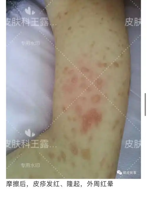 皮肤肥大细胞增生症附典型病例