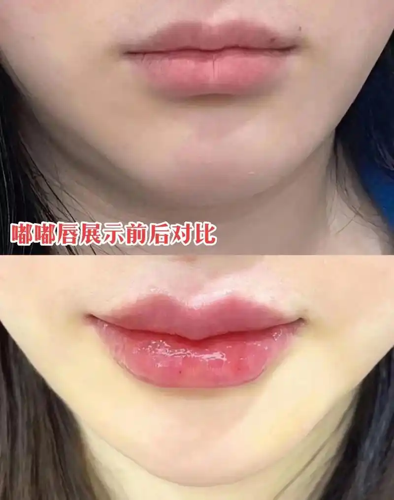 高品质雾化供应  #嘟嘟唇#玻尿酸 #面部提升 - 抖音