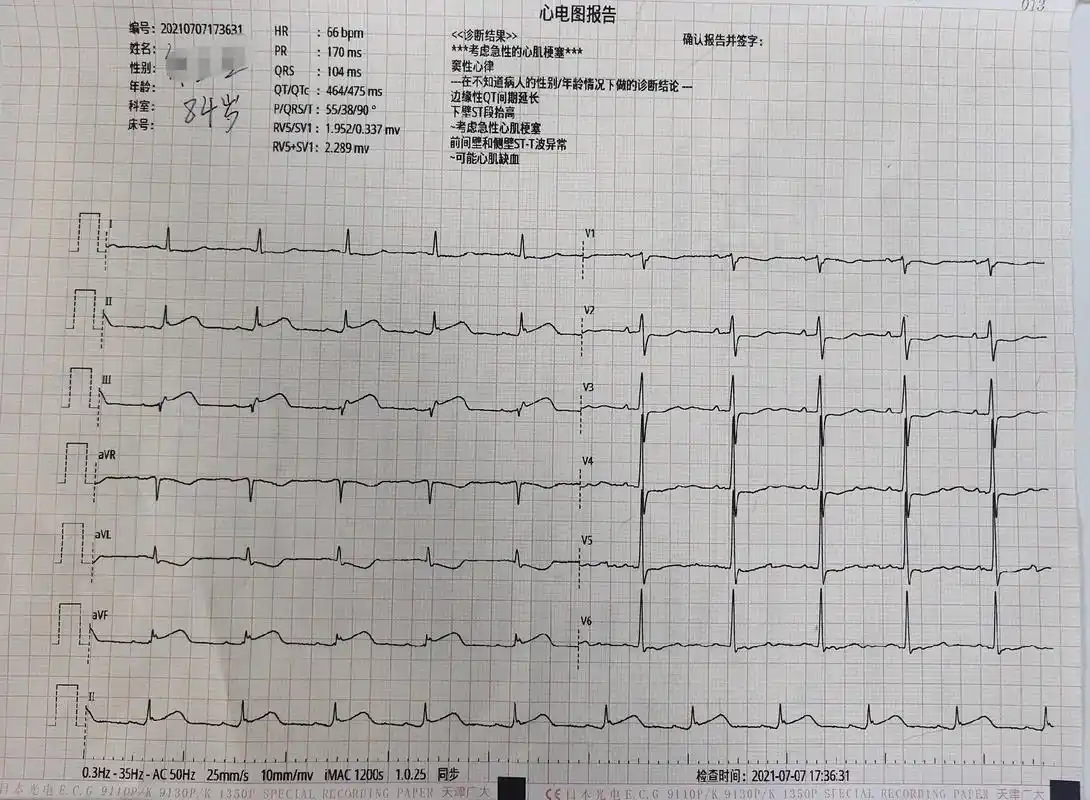 抢救高龄急性心肌梗死老奶奶