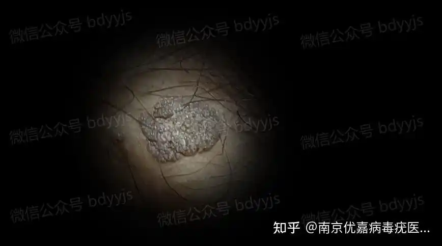 男性尖锐湿疣是比较常见的性病之一,它与梅毒,淋病,艾滋病等性传播