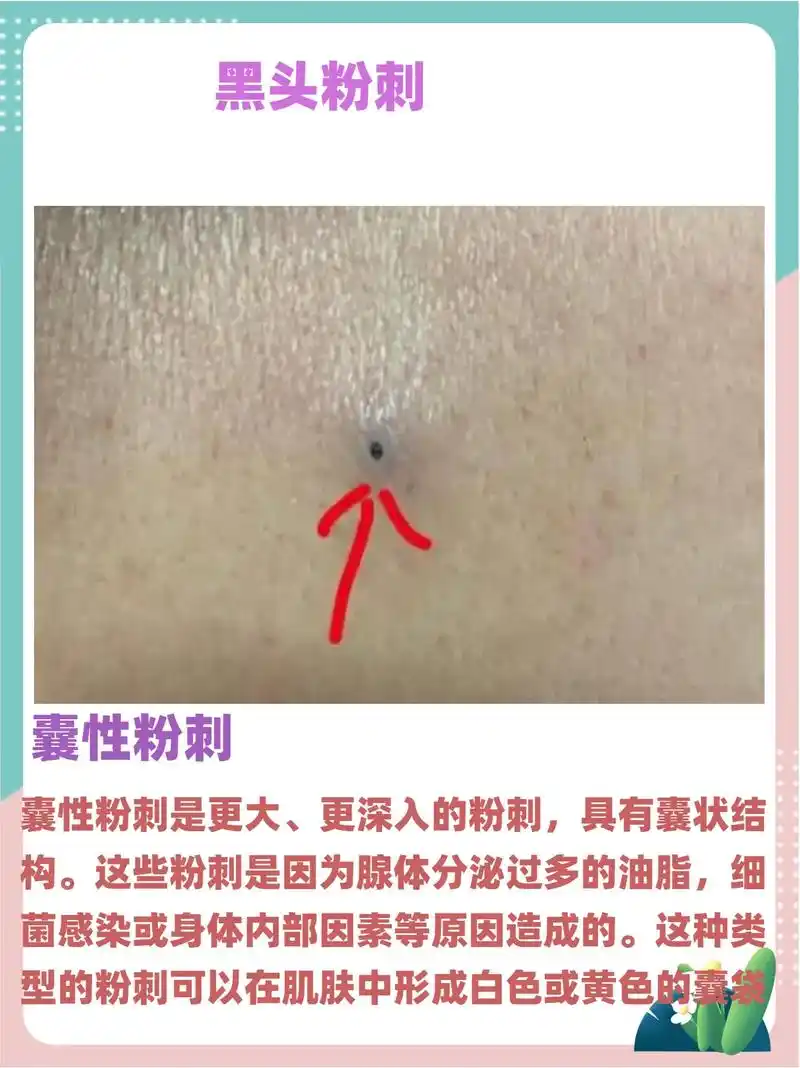 黑头粉刺的类型. - 抖音