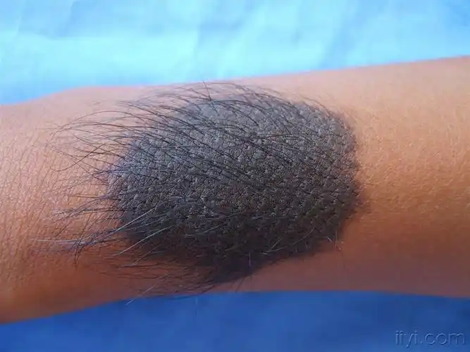 皮肤病先天性色痣