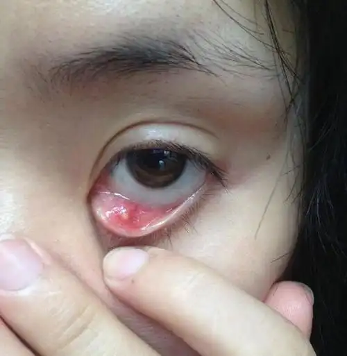 两个简便小偏方 轻松治好麦粒肿