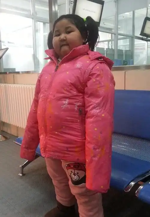 研究发现:儿童肥胖会影响肝脏健康