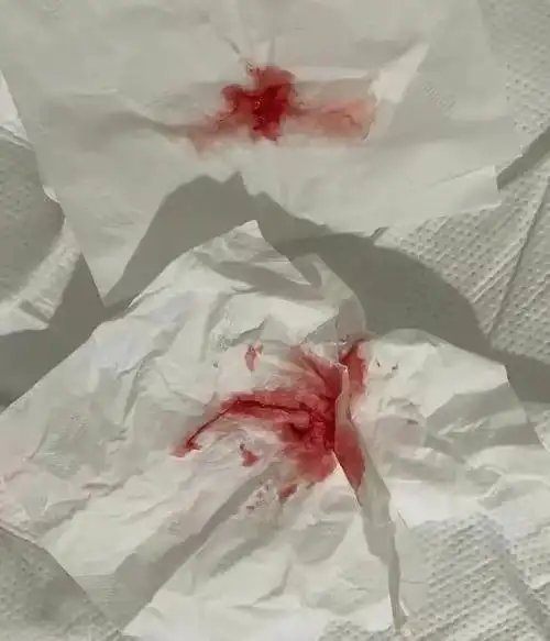 就在3月20日晚上,布布的病情继续恶化,肿瘤在不受控制地变大,已经压迫