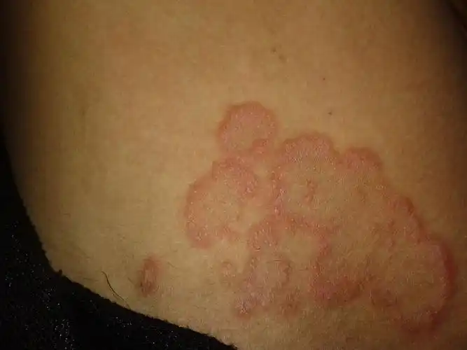 大腿内侧两边都是这种情况 请问是蟑螂咬的吗? 如果不是 那是什么虫子