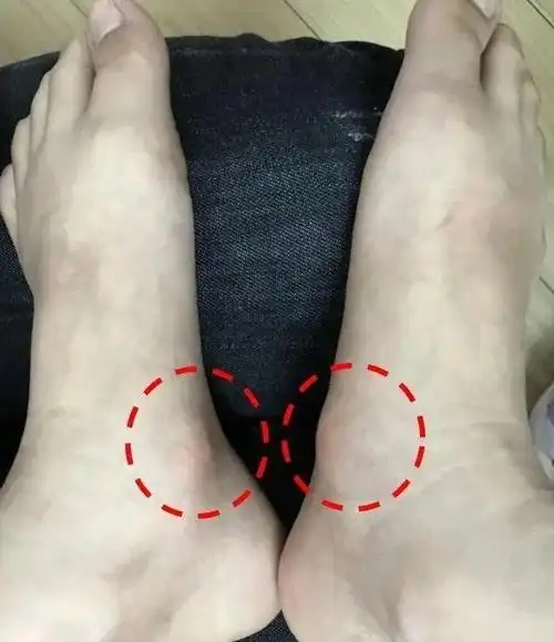 青少年足痛当心副舟骨疼痛