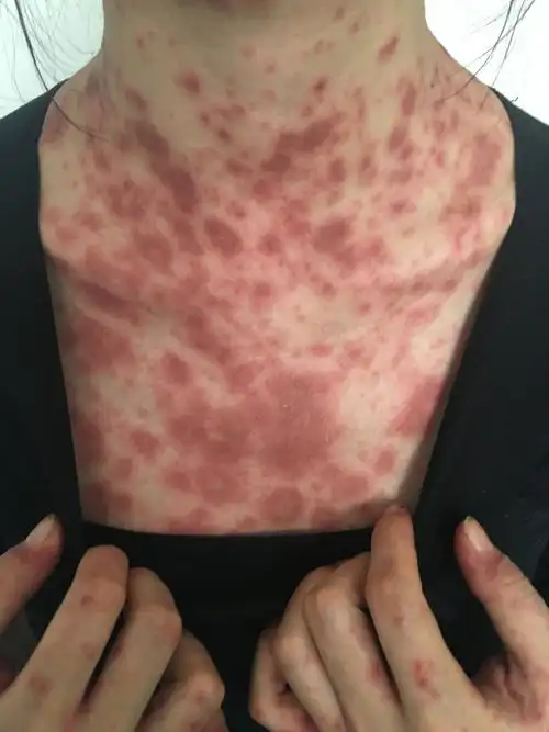 类似狼疮皮肤血管炎的干燥综合征患者 - 好大夫在线