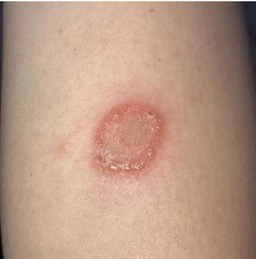 皮肤真菌感染怎么办 - 好大夫在线