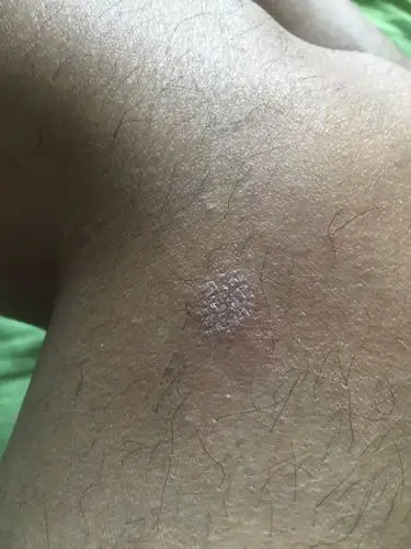 腿上起一片片的 有白皮 扣掉后又出来 抠的时候有点痒