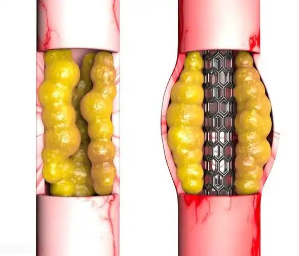 发现一根主干血管堵塞,植入支架开通了血管;而医生却让另一个患者赵
