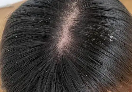 头皮油脂分泌旺盛怎么办?去屑小妙招有哪些?