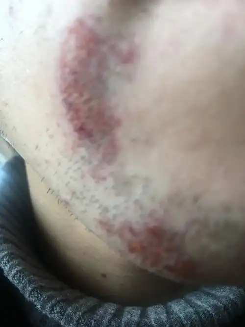 我的面被脱毛膏烧伤多久能好