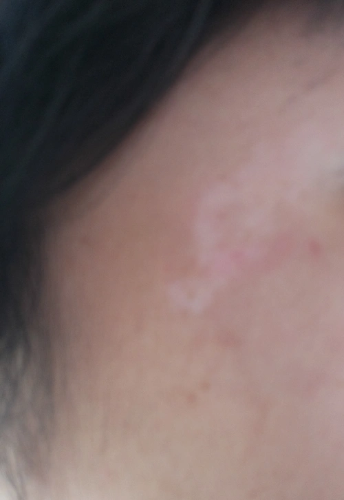 我脸上长了一块白斑,是白癜风吗?谢谢