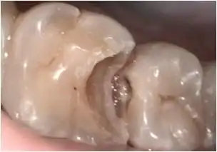 图一 治疗前,龋齿发生在磨牙咬合面,看起来龋洞不太大.