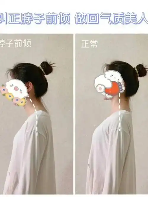 女性脖子前倾有哪些危害?颈椎曲度体态矫正训练方法有哪些?