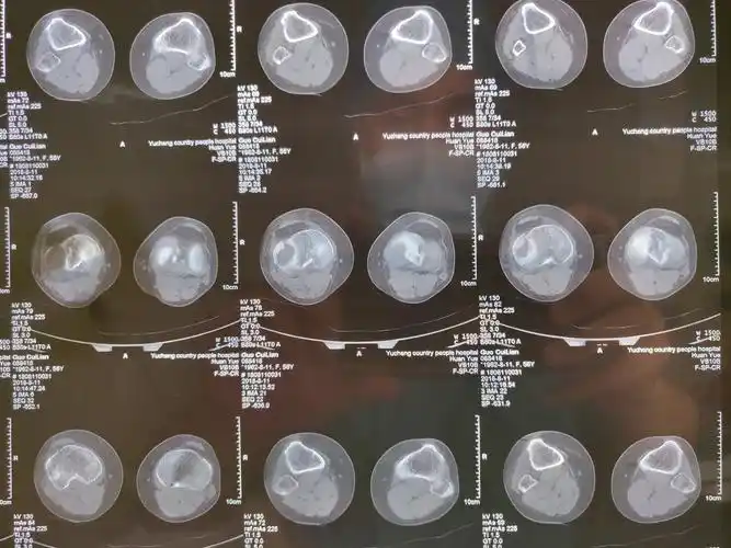 胫骨平台骨折的微创治疗