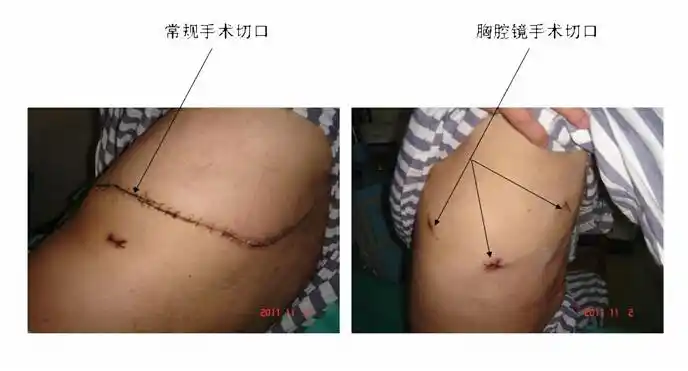 肺肿瘤与微创治疗