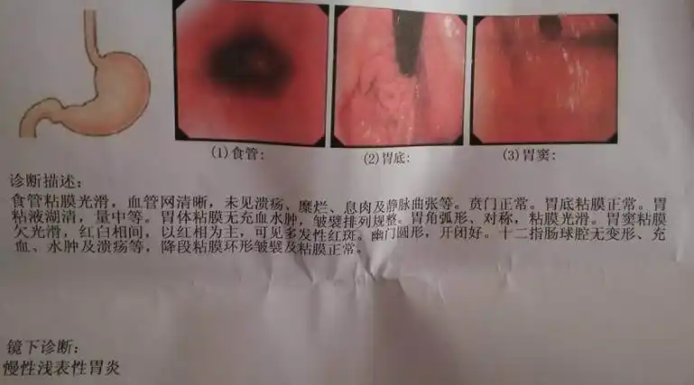 就是胃病慢性浅表性胃窦炎的一种呀慢性浅表性胃窦炎,如果总出现腹胀