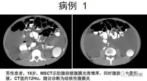 腹腔积液的良恶性表现与鉴别