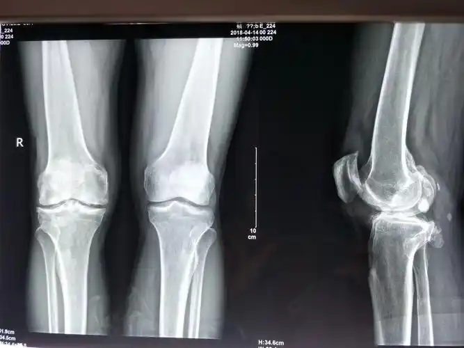 膝关节炎伴内翻畸形