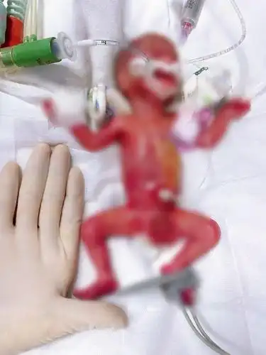 出生仅400克!湖南第一轻,全国第二轻的