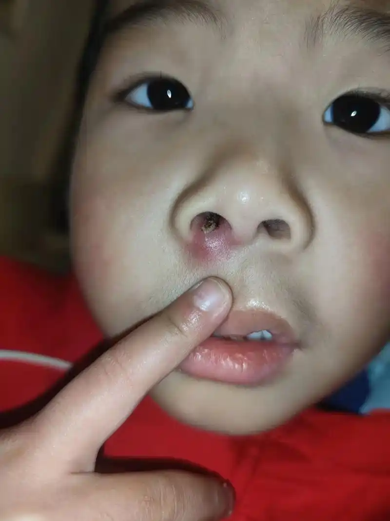 为啥阳了后鼻子里面长那么大脓包?