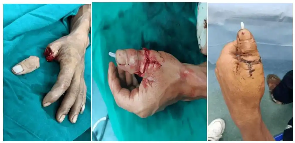 离断手指奇迹"复活" | 云县人民医院急诊创伤外科常规开展断指再植术