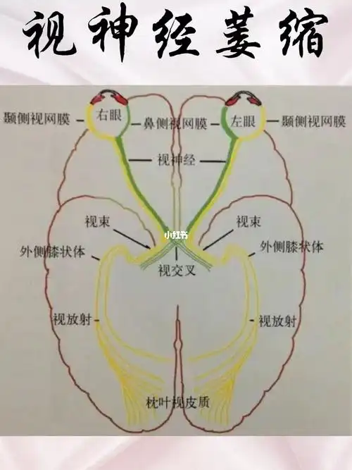 视力  #眼睛  #视神经萎缩