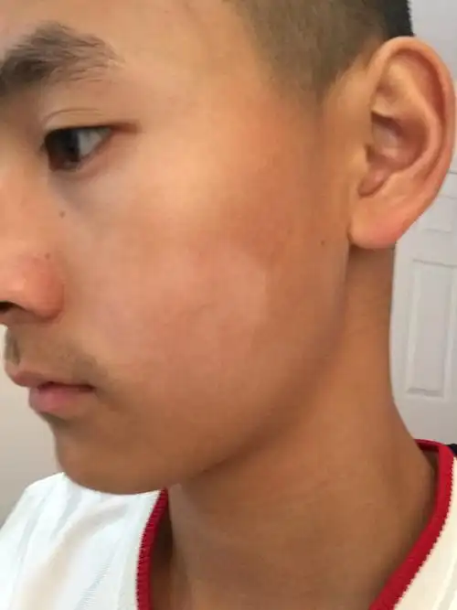 脸上有白斑大概两个月了现在皮肤变的很光滑没有皮屑不痛不