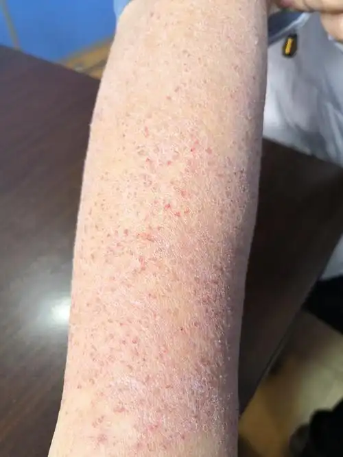 这个患者是位美女,特应性皮炎多年,最近爆发,全身皮肤脱屑瘙痒.