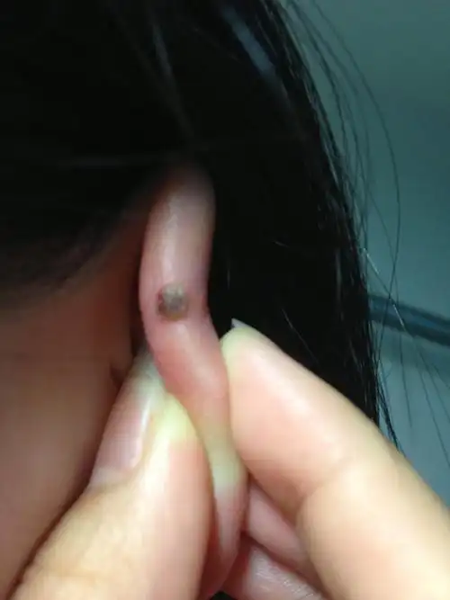 左耳耳廓上长了一个黑绿色突起的结痂状痣,不知是否有癌变可能,求专业